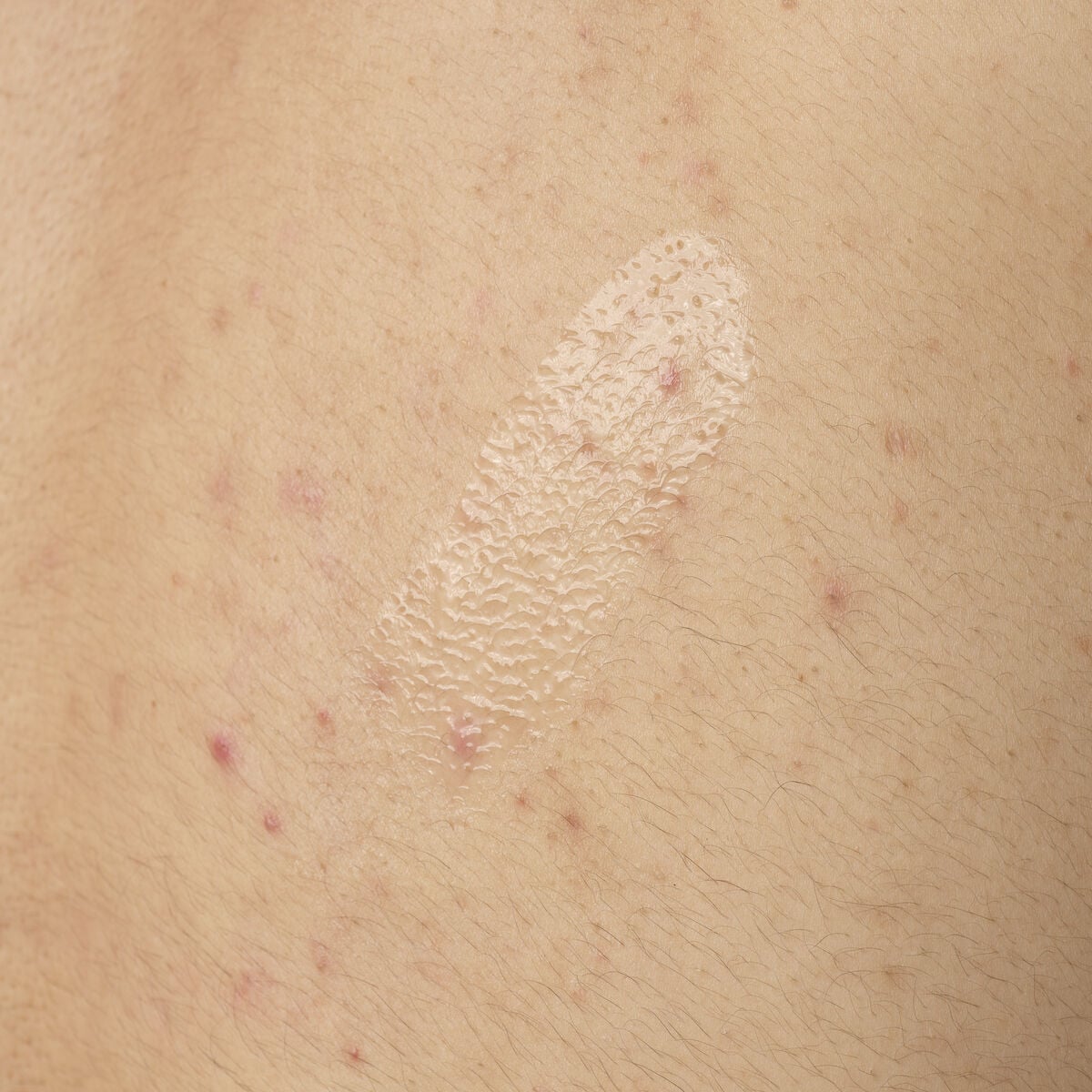 salicylic-acid-0-5-body-serum-l4 ORD-salicylic-acid-05-body-240ml-application.jpg