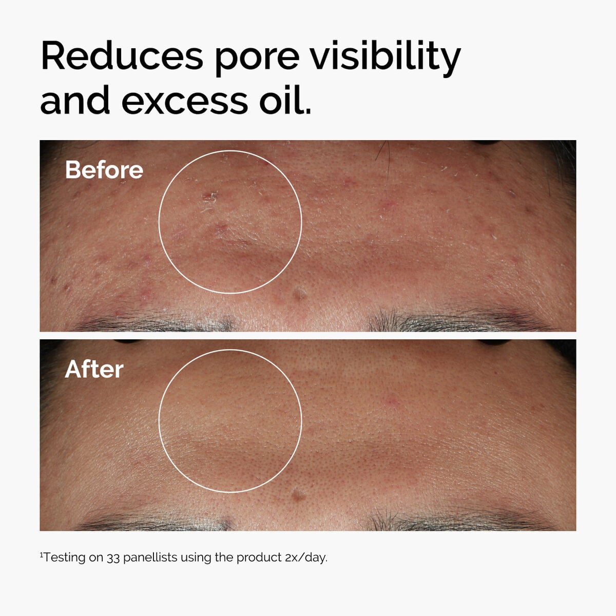 niacinamide-10-zinc-1-x3 ord-niacinamide-zinc-blemish-serum-before-after-pores.jpg