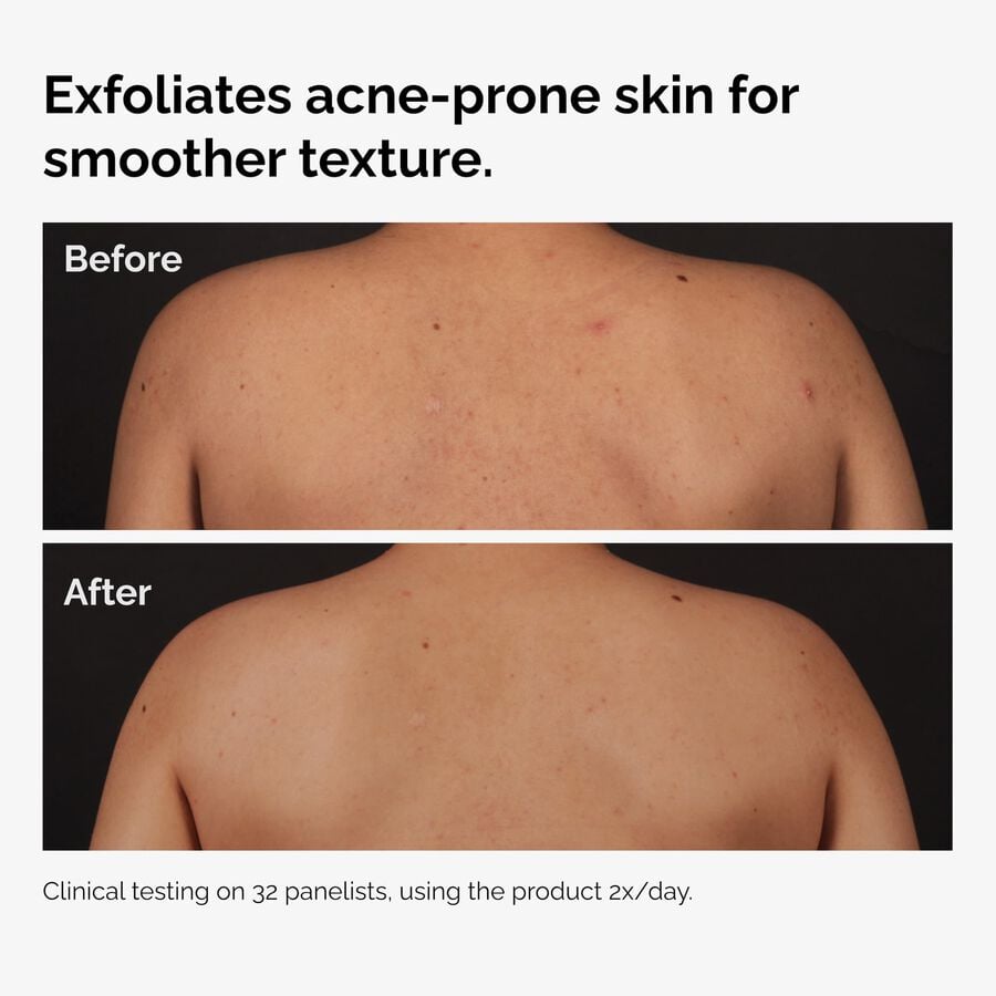 the-body-care-collection-m2 ord-salicylic-acid-body-serum-before-after-graphic-NA.jpg