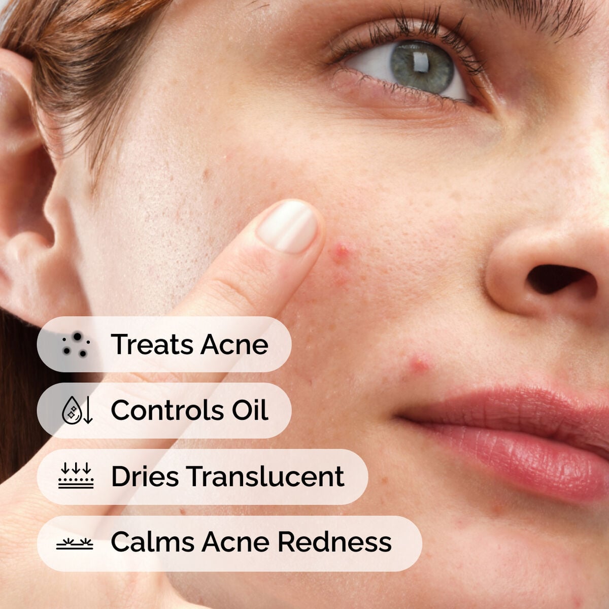 sulfur-10-powder-to-cream-concentrate-y7 ord-sulfur-10pct-powder-to-cream-concentrate-model-application-with-benefits-acne.jpg