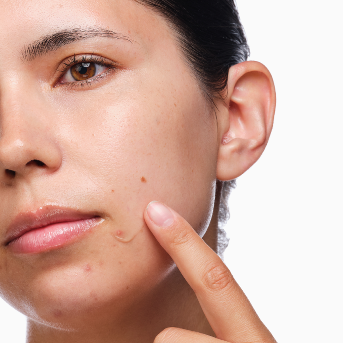 the-acne-set-e0 rdn-the-acne-set-application.png